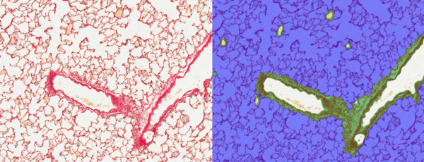 image analysis of lung parenchyma