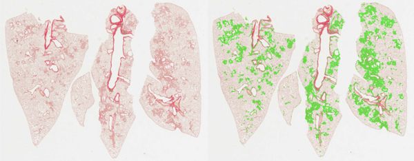 image analysis of fibrotic lesion