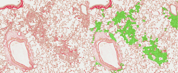 automated image analysis of fibrotic lesion