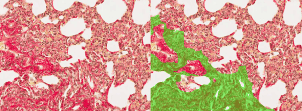 image analysis of fibrosis