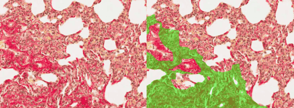 image analysis of fibrosis