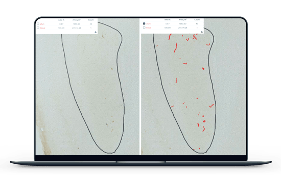 alpha-synuclein immunoreactivity with AI