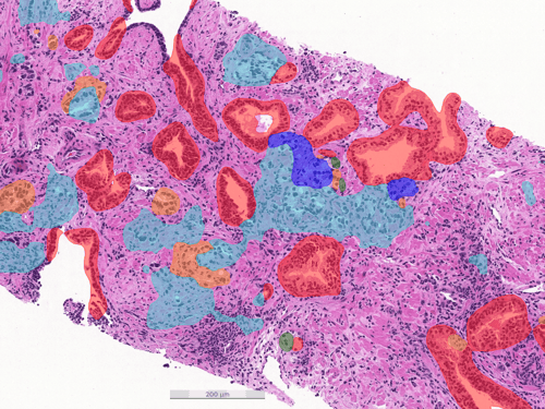 prostatecancer-grading-after
