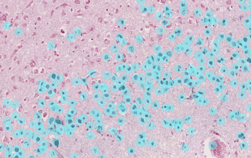 Iron detection after AI detection