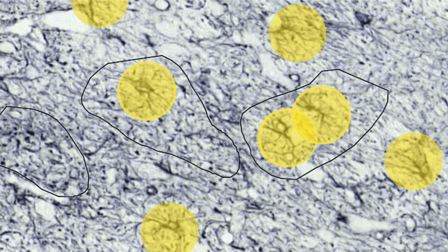 Case study: benefits of AI in Parkinson’s disease image analysis