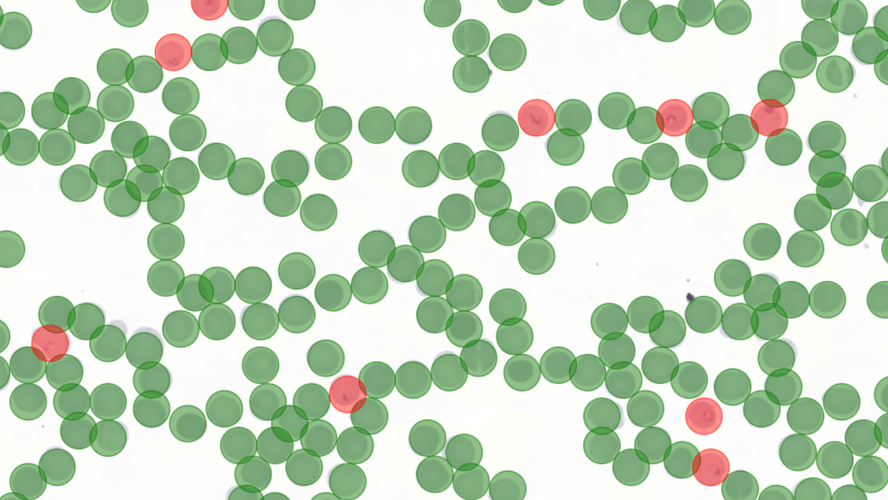 Case study: automating the detection of malaria parasites in blood smear