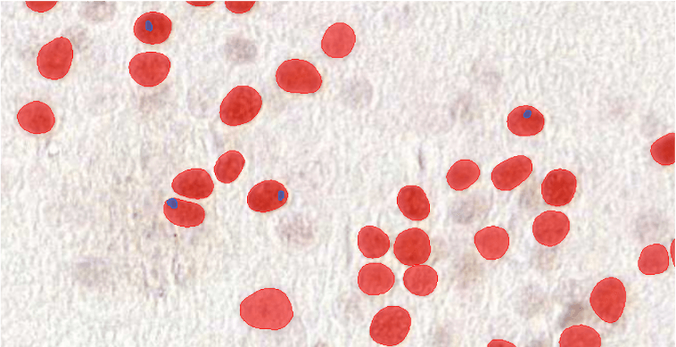 Case study: benefits of AI in Huntington's disease image analysis
