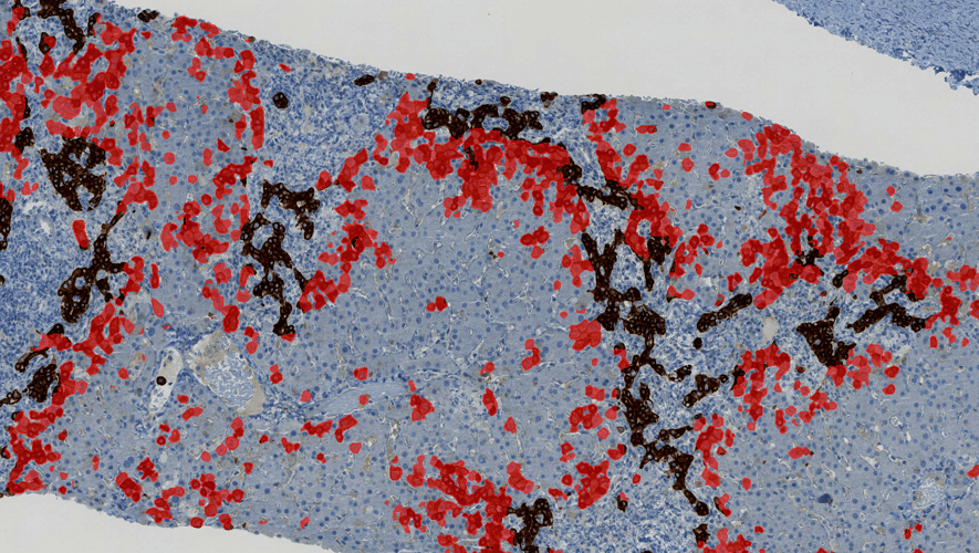 Case study: evaluating prognostic indicators in primary sclerosing cholangitis with AI