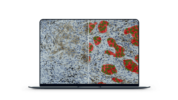 PD-L1 detecting AI model