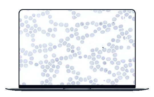 laptop_malaria