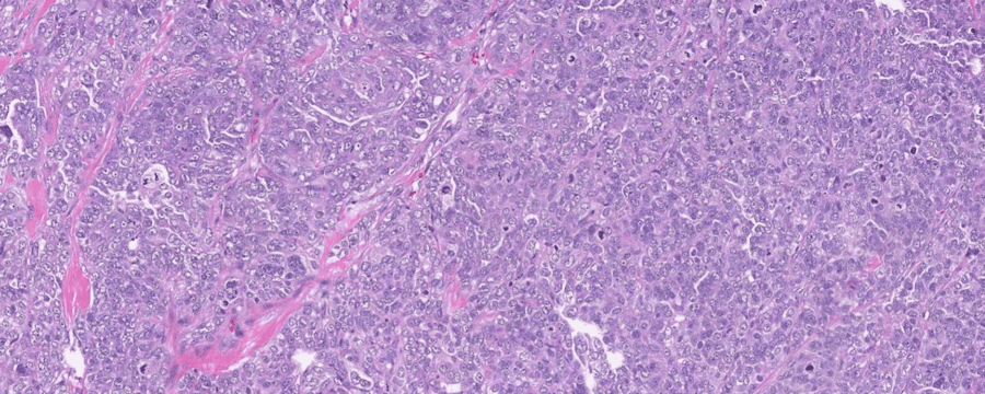 Case study: AI-based image analysis enables prognostication in ovarian cancer