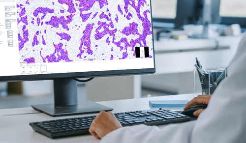 How AI can improve the speed and accuracy of breast cancer diagnostics