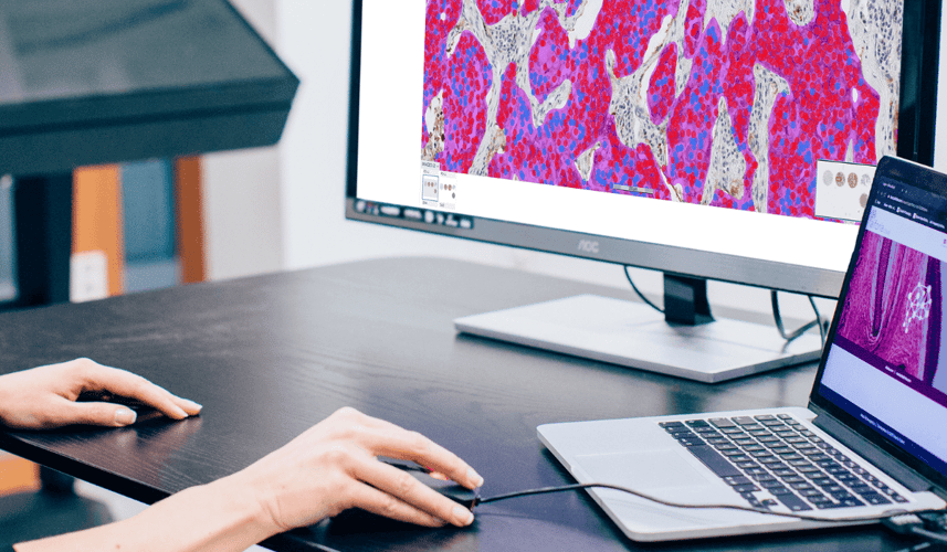 Case study: enhancing mesothelioma research with AI
