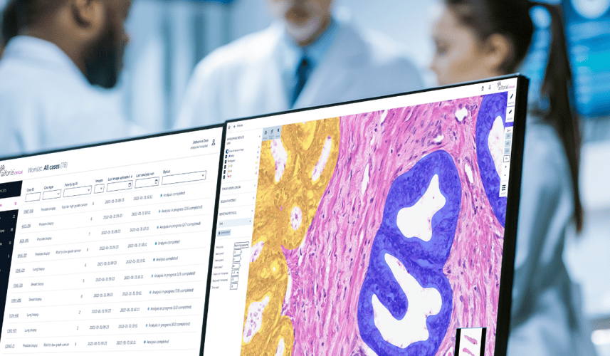 AI enhances detection of high-risk prostate cancer features