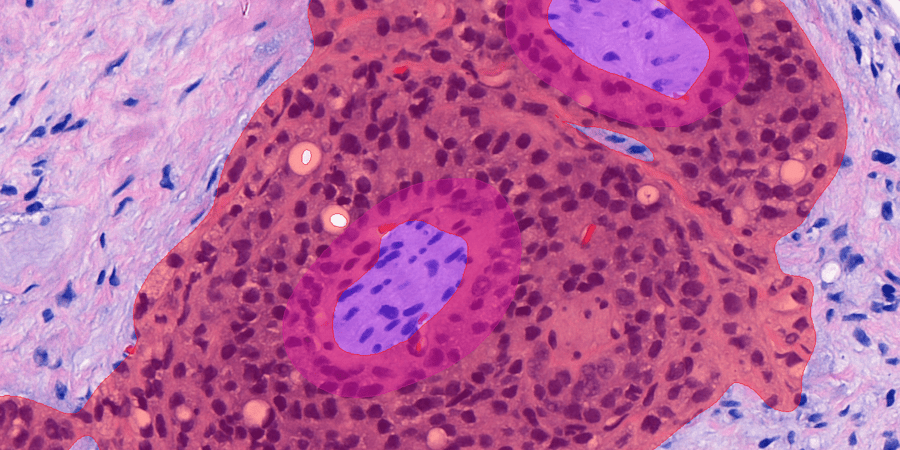 Case study: AI-assisted prostate cancer diagnosis