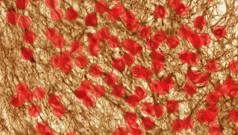 Blog Image - Parkinson’s disease 3-1