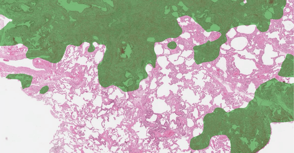 dr-smith-case-study-advanced-fibrosis-carousel