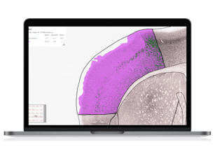 Synuclein_Parkinsons_Laptop