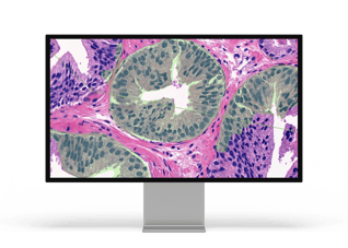 Prostate Cancer HG-PIN_monitor 1