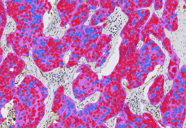 Lung_PDL1_20x_1_AImasks_Enhanced