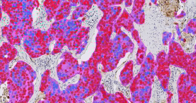 Aiforia® Lung Cancer PD-L1