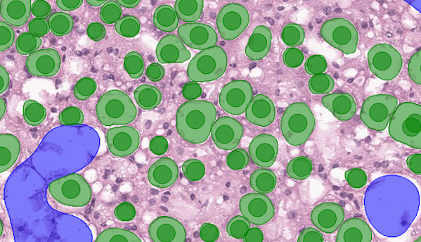 dr-smith-case-study-liver-pathology-blog-carousel