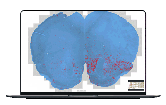 alpha-synuclein immunoreactivity with AI