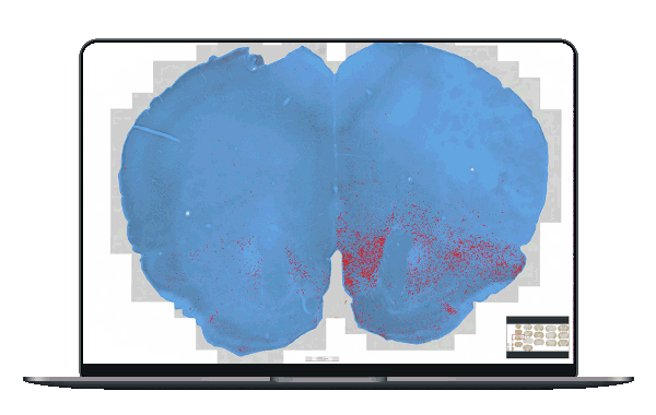 alpha-synuclein immunoreactivity with AI