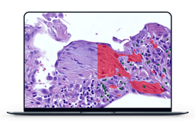 histopathological features of idiopathic pulmonary fibrosis