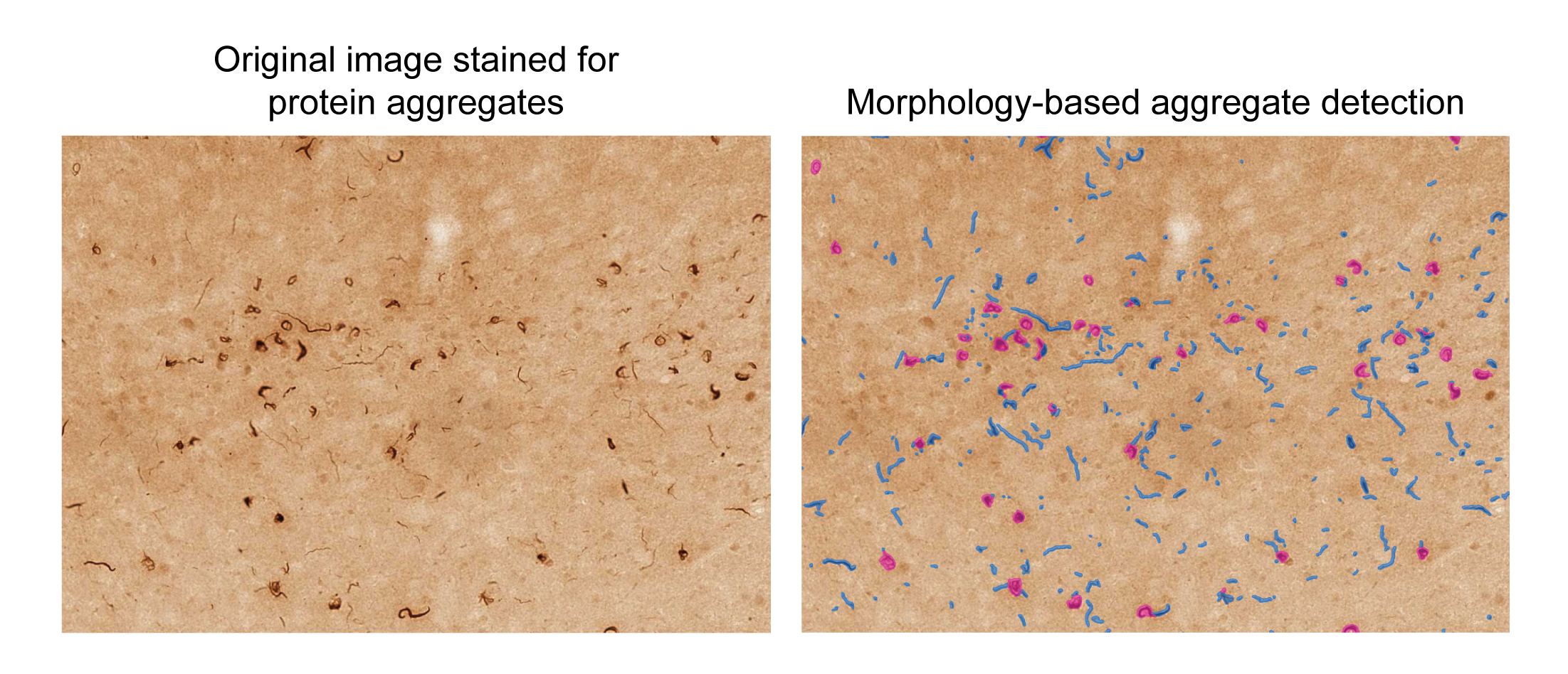 pSyn aggregate detection