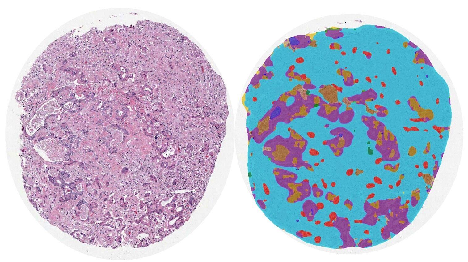 Leveraging AI-driven quantitative pathology to identity novel prognostic histologic signatures in colorectal carcinoma