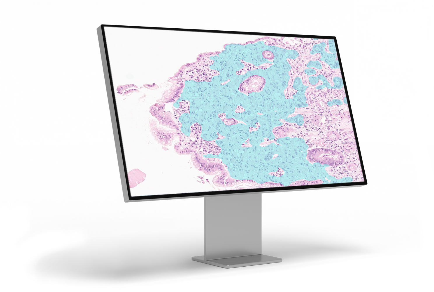 Gastric cancer_monitor left angle_1-1-1