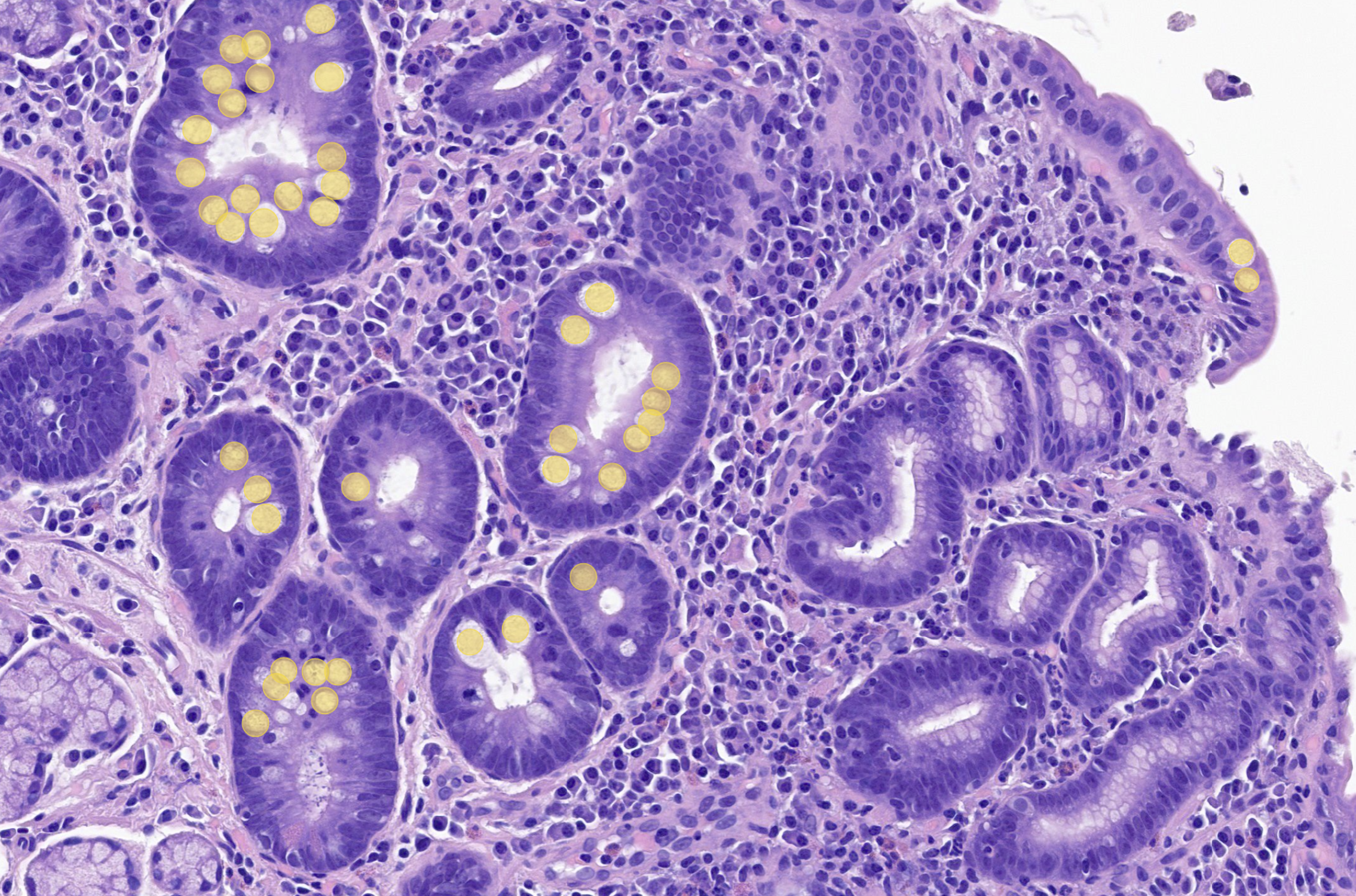 Gastro2.0_Metaplasia_objects2