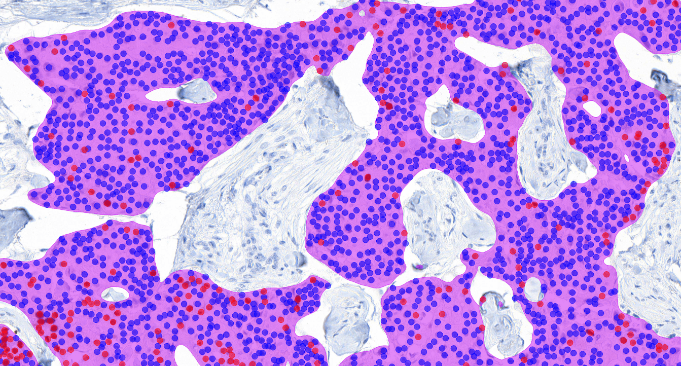 Optimizing the pathology workflow with Aiforia® Breast Cancer Suite