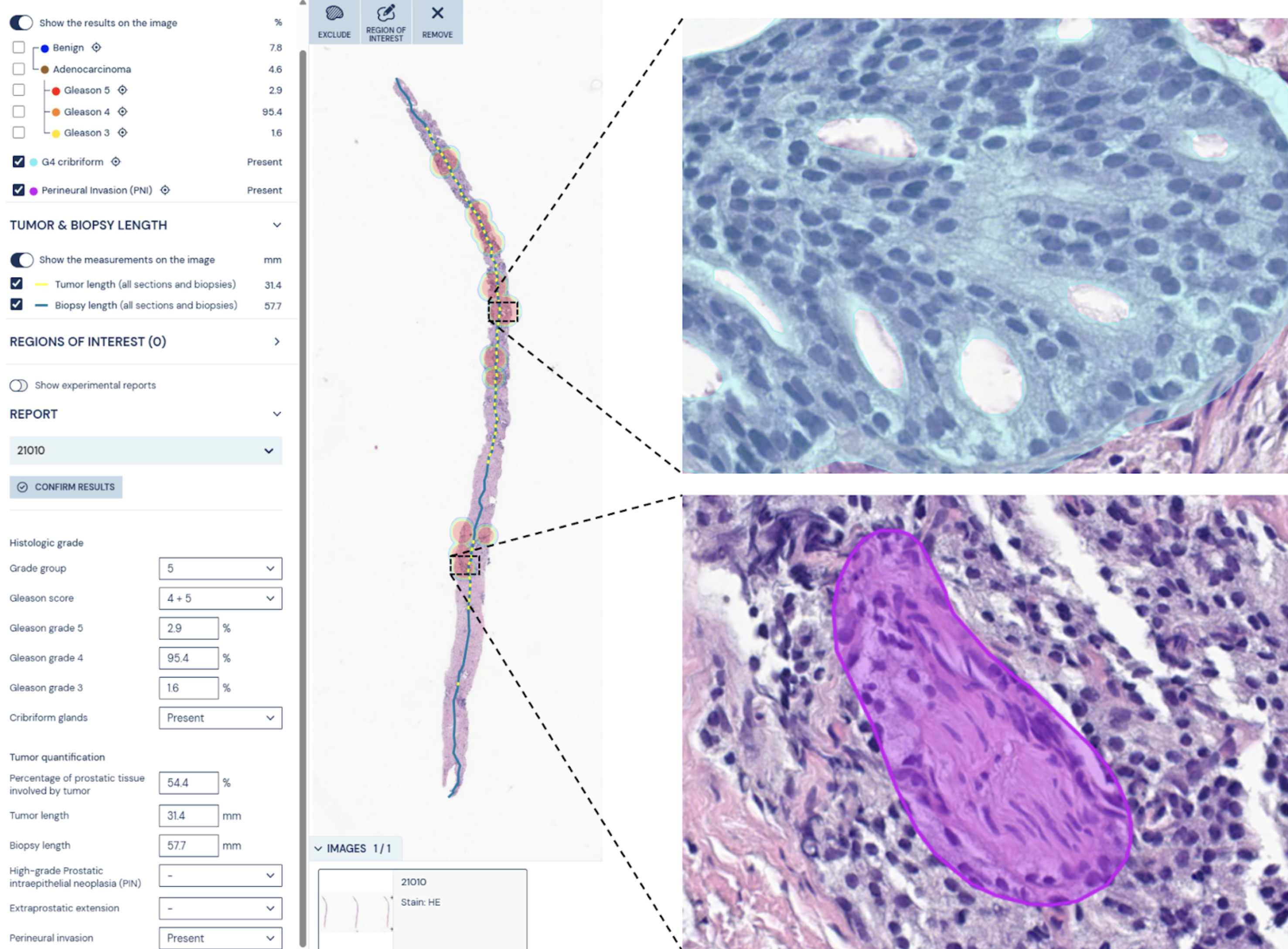 Aiforia Prostate Cancer Suite_key features image