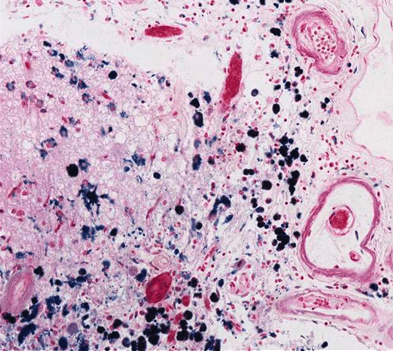 Deep learning assisted histopathological markers in Alzheimer’s disease