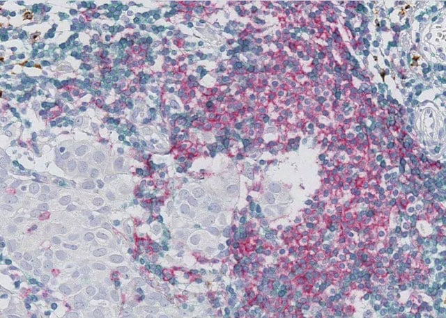 Breast cancer_T, B-cells, dendritic cells_before