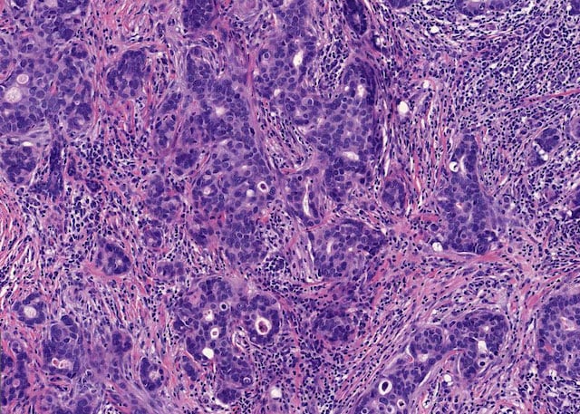 Breast cancer_grading_before