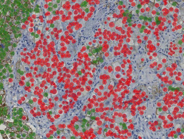 Lung-PDL1_after