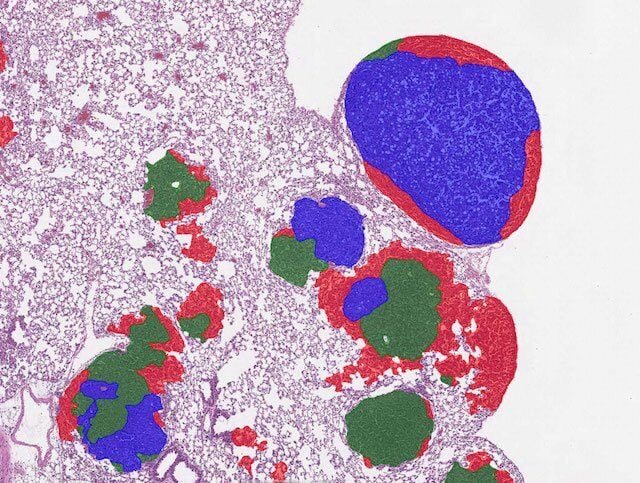 Tumor_grading_MIT_after