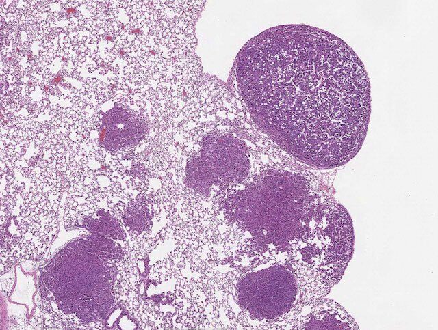 Tumor_grading_MIT_before