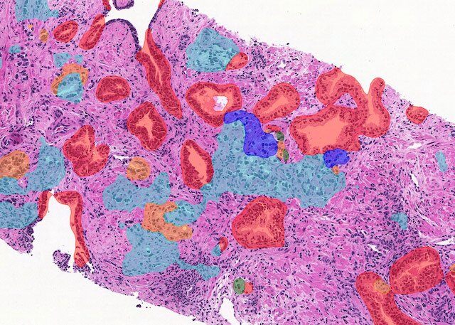 prostate_grading_after