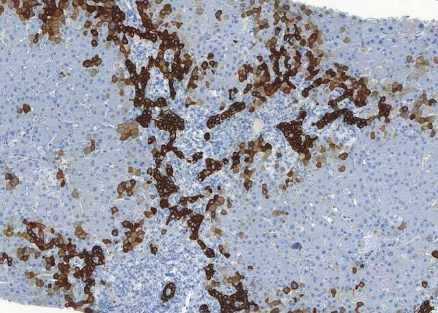 Case study: AI models aiding chronic cholestasis detection