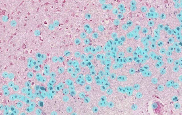 Massachusetts General Hospital case study: Alzheimer's disease research with AI