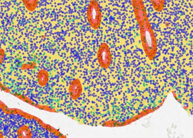 endometrium_epith+stroma_after