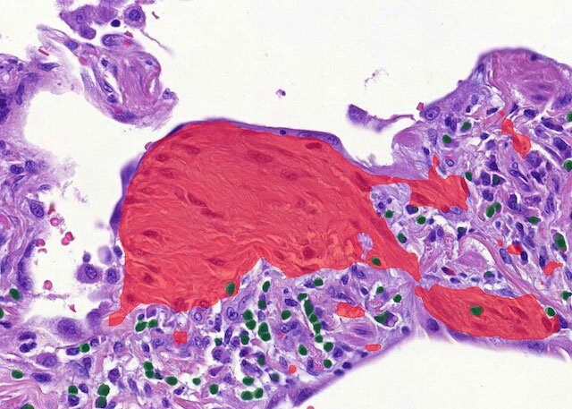 lung_fibroblast_lymphocytes_after