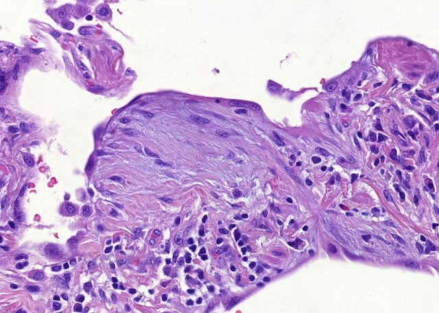 lung_fibroblast_lymphocytes_before