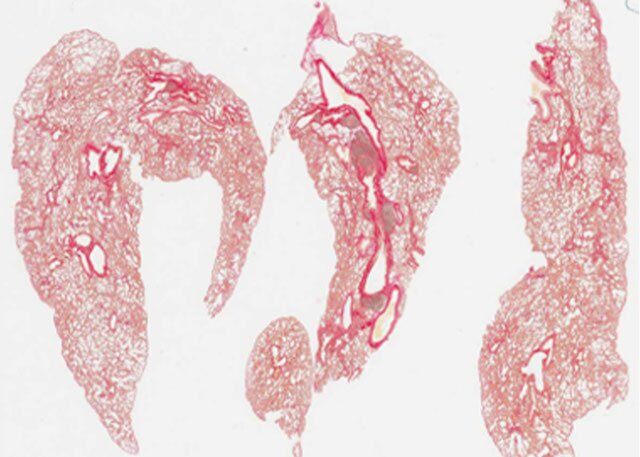 lung_fibrosis_before