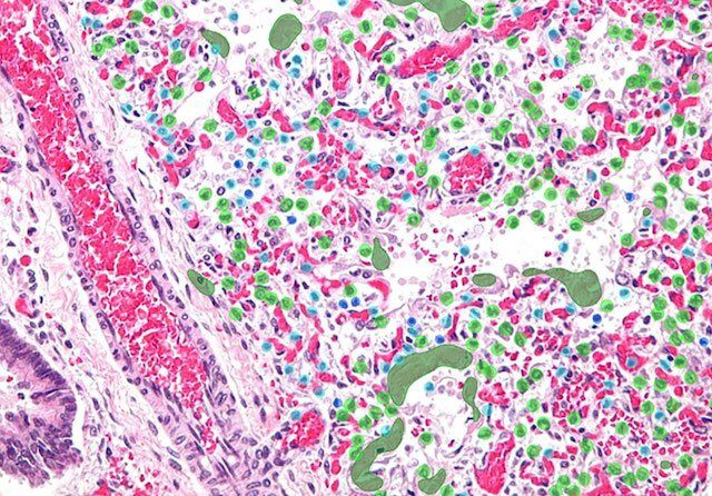 respiratory_disease_after