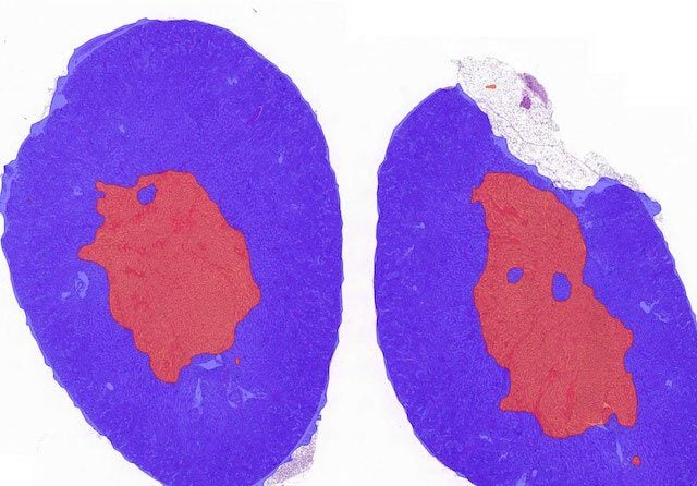 Galileo case study: exploring AI’s potential in kidney transplantation